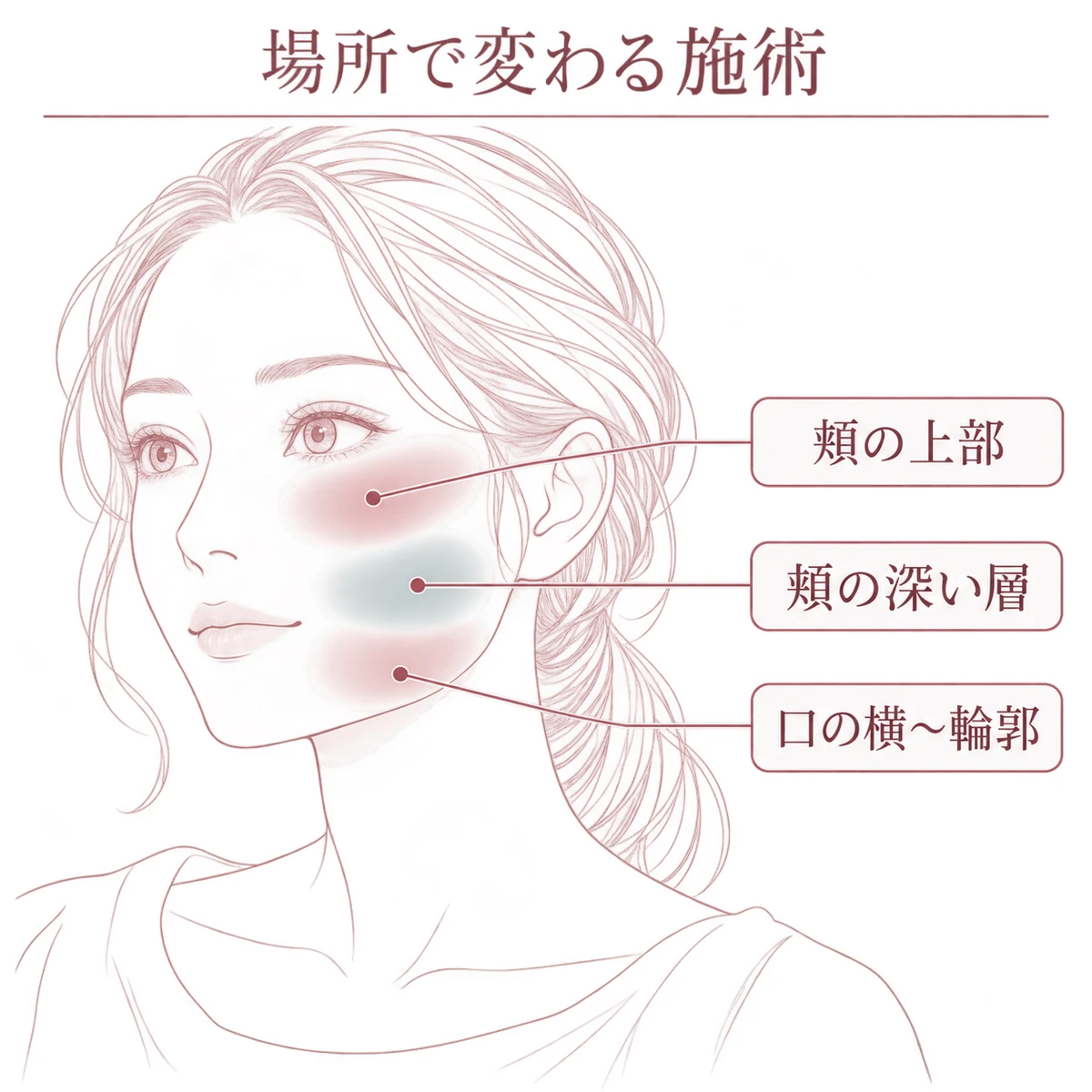 頬の上部、頬の深い層、口の横から輪郭付近にある3つの脂肪の位置を示した顔の図
