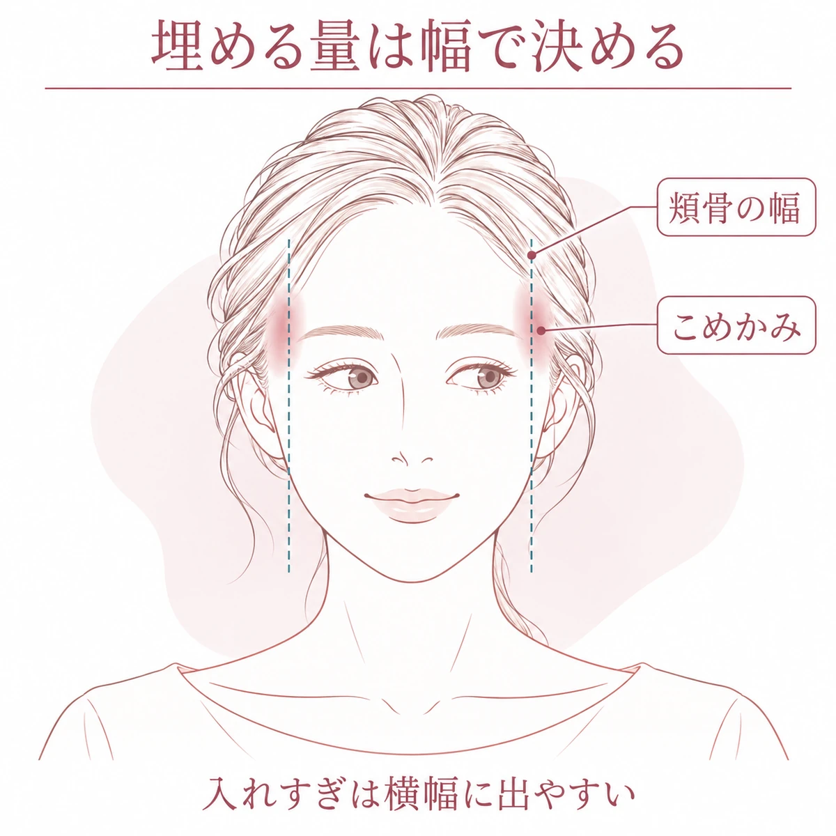 頬骨の幅を目安に、こめかみへ脂肪を入れる範囲を検討する正面顔の図