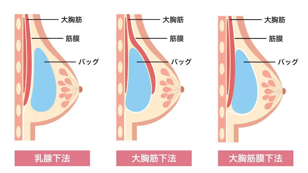 シリコンバッグの挿入方法