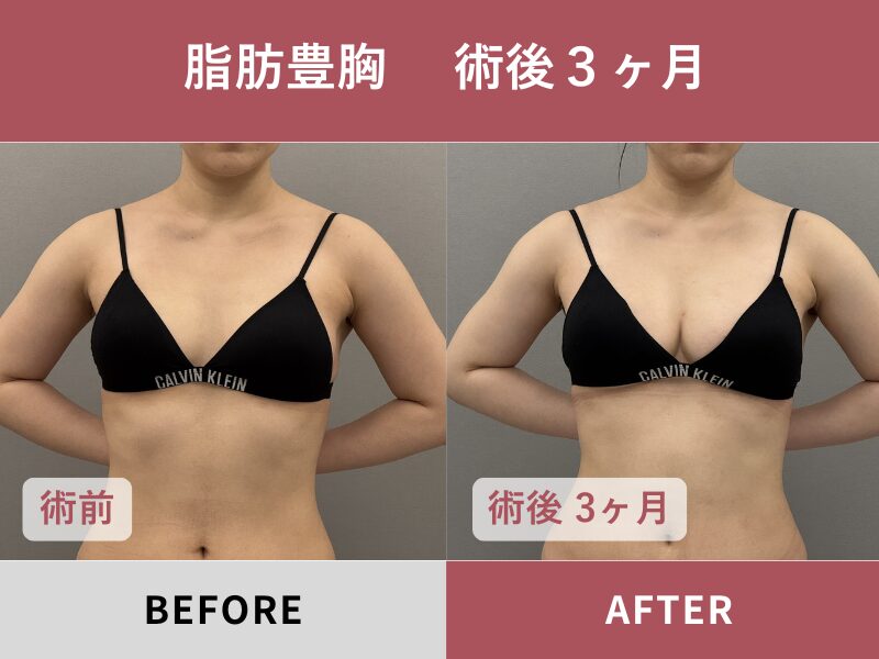 脂肪豊胸（術前・術後）