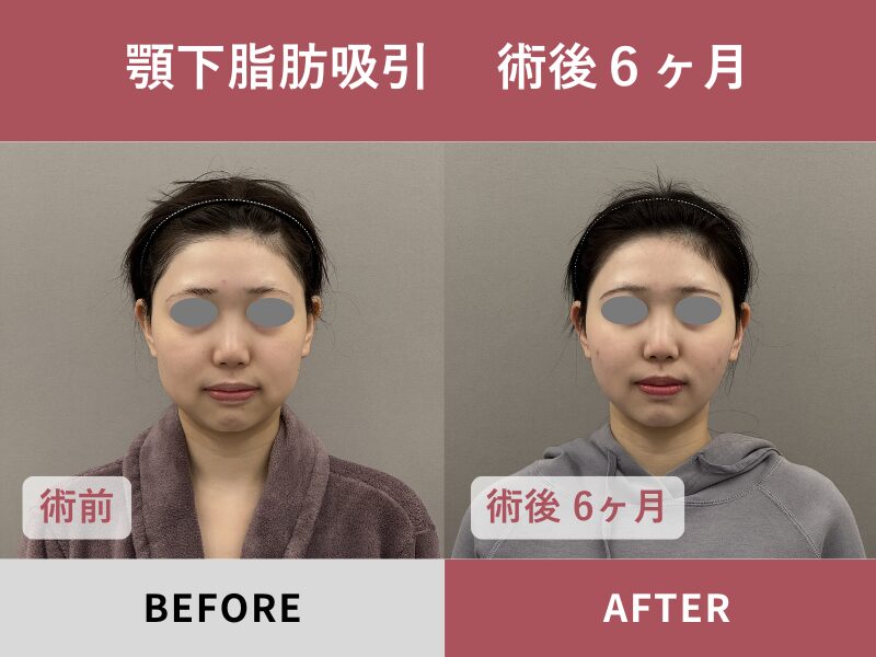 顎下脂肪吸引（術前・術後）
