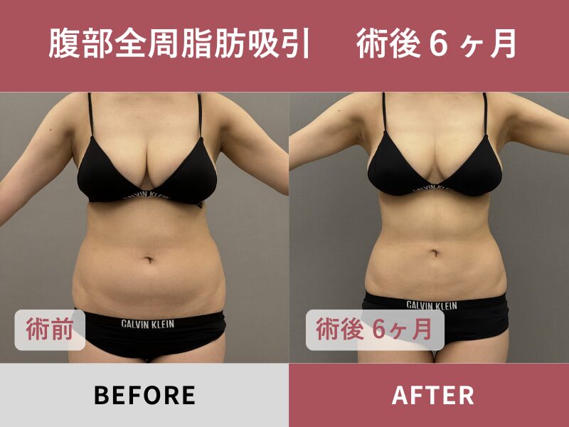 腹部全周脂肪吸引