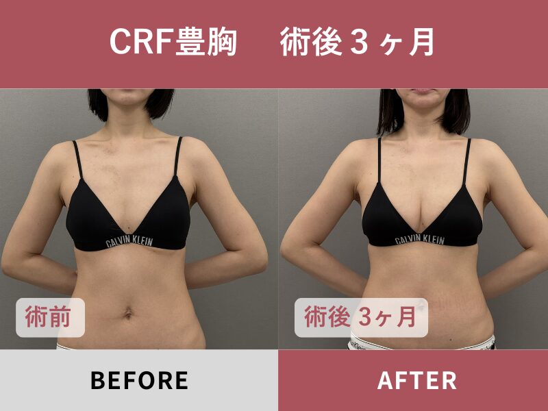CRF豊胸