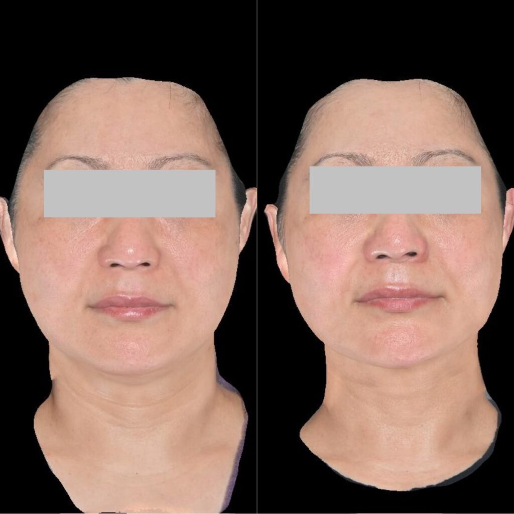 スカルプトタイト症例①50代女性/正面